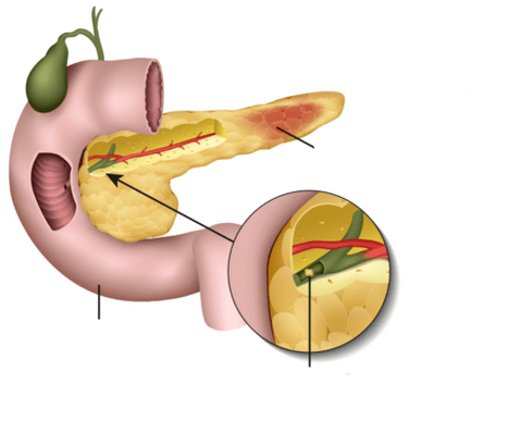 A pancreatite é a inflamação do pâncreas